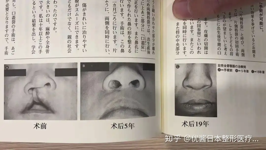 王菲女儿的三次唇腭裂修复手术，让我们看见日本美容外科医生背后的实力