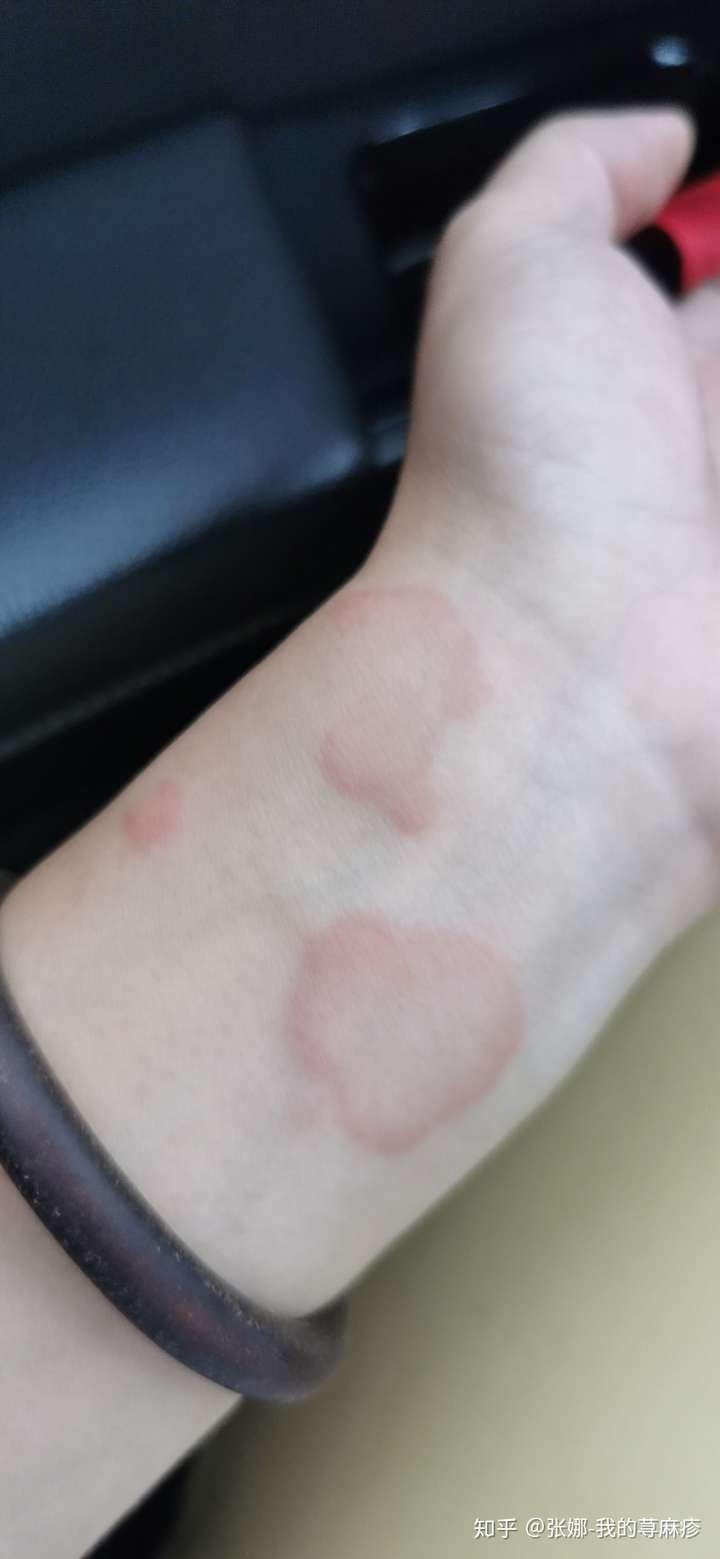 皮肤病 慢性荨麻疹 胆碱能性荨麻疹 急性荨麻疹 寻麻疹长什么样子?