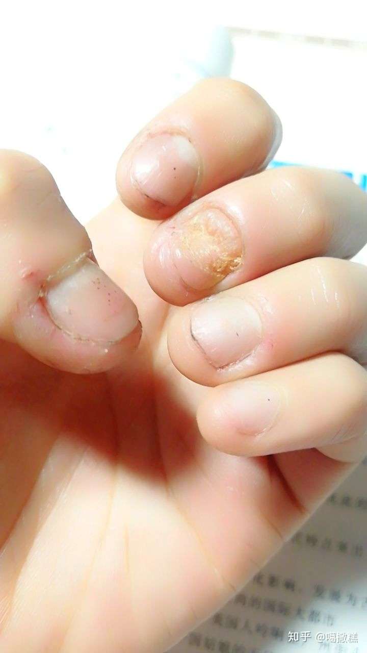 咬指甲怎么戒除?