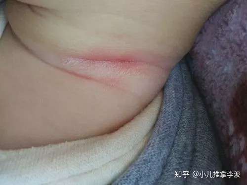 小儿推拿李波夏季宝宝淹脖子发红又破皮怎么办如何正确护理