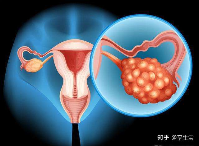 享生寶哪些女性容易招惹卵巢囊腫備孕遇上卵巢囊腫怎麼辦