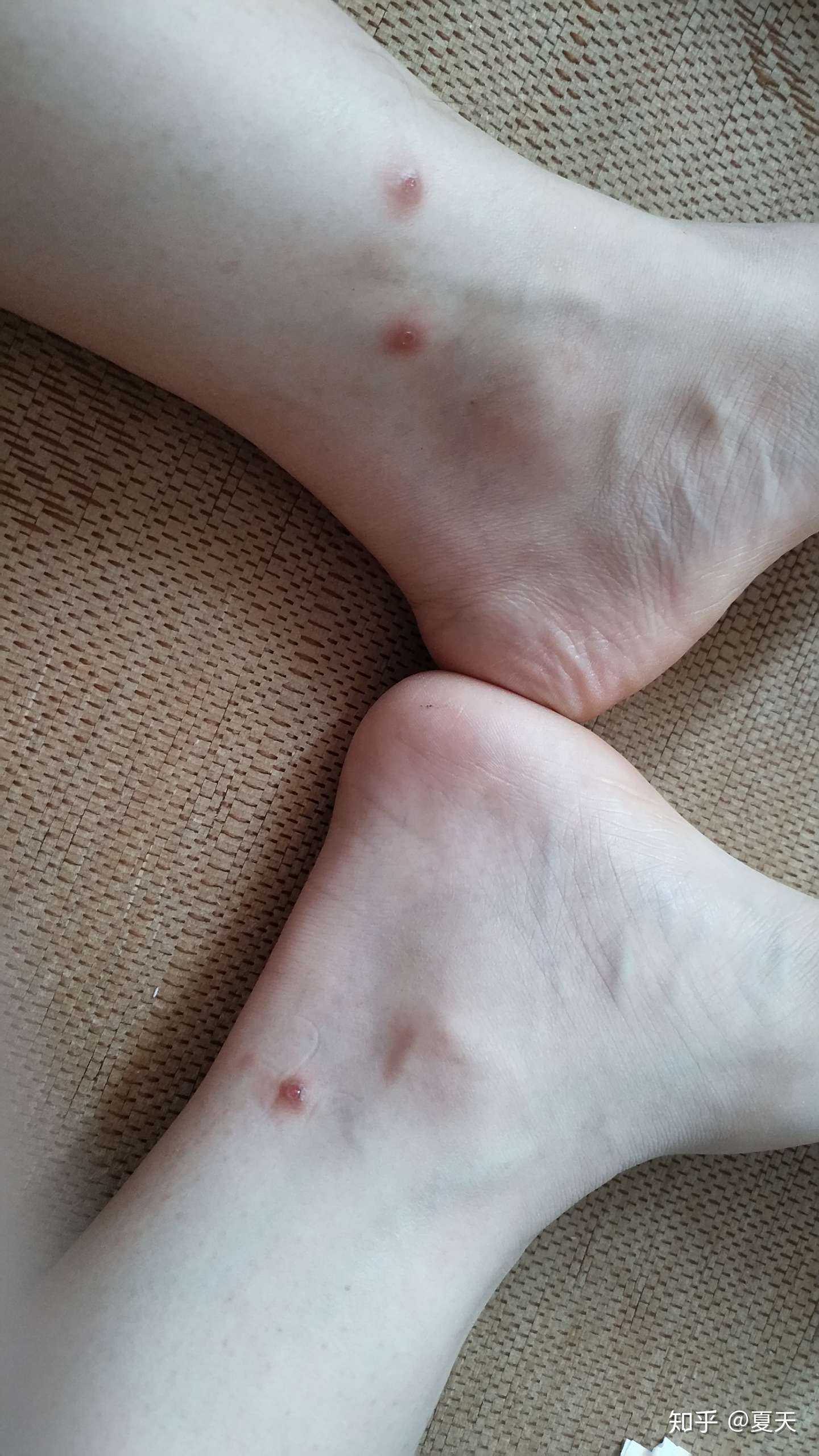 奇痒无比的湿疹治疗历程 知乎