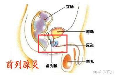 慢性前列腺炎带给你得痛苦怎么办?
