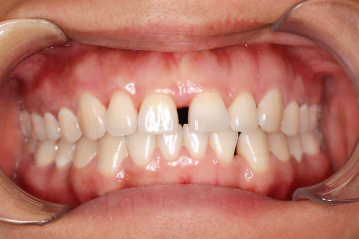 你会因为什么想去做牙齿矫正?