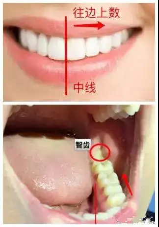 怎么判断是不是长智齿图片