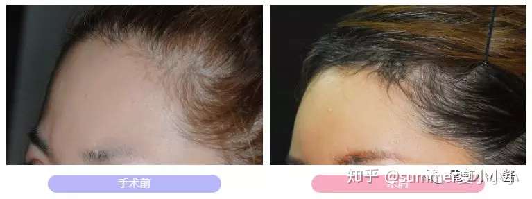 实操案例 禁得起折腾的脸都有个好看又自然眉骨 知乎 实操案例 禁得起折腾的脸都有个好看又自然眉骨 知乎