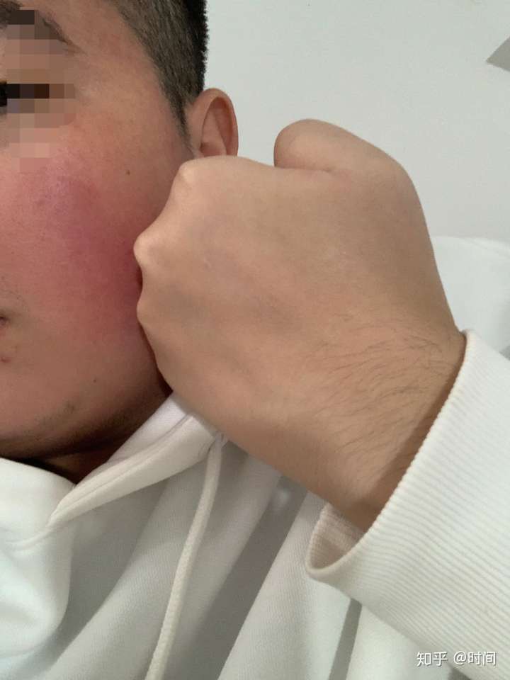 红血丝怎么去除呢?