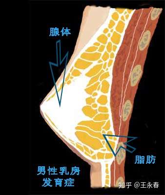 手术摘除腺体是很容易理解的;吸脂的操作主要针对乳房内部的脂肪组织
