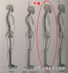 so,如果长期保持这样的姿势,可能会导致平背综合症,也称胸椎过度伸展