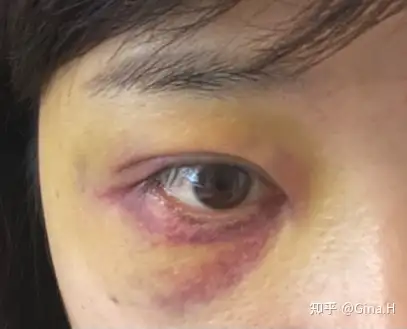 记录眼周淤血(熊猫眼)恢复过程