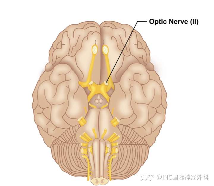视神经胶质瘤怎么保视力世界颅底肿瘤手术大师的手术全切策略