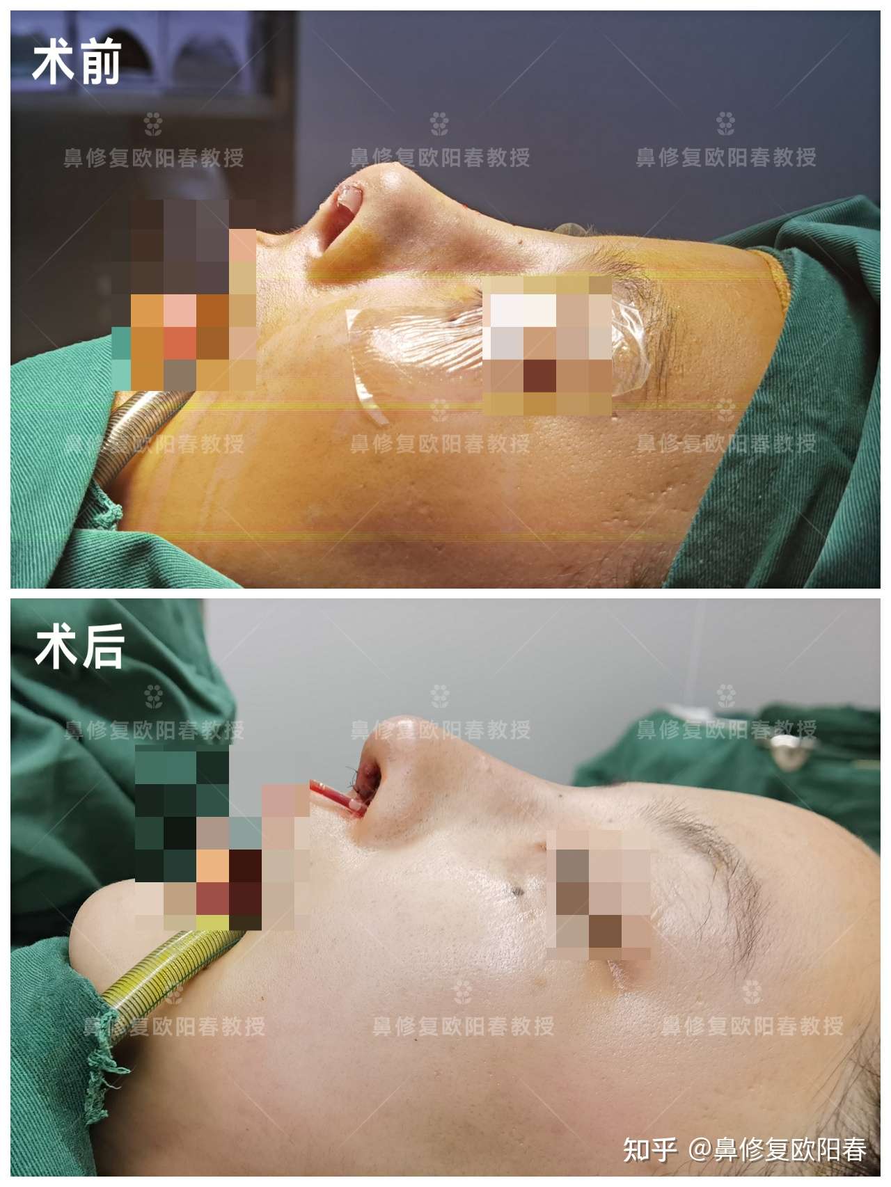 假体穿出鼻头挛缩2全肋鼻修复术后即刻