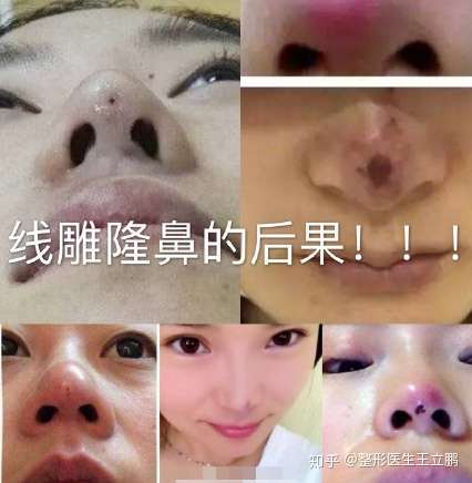 做线雕鼻后可以又取出来吗