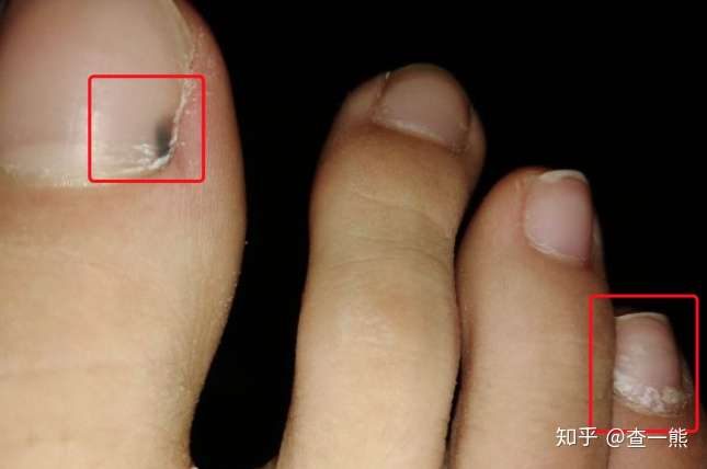 脚指甲里的黑色脏东西怎么处理