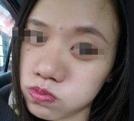 鼻头缩小一定会增生吗会变得比原来的鼻子还大