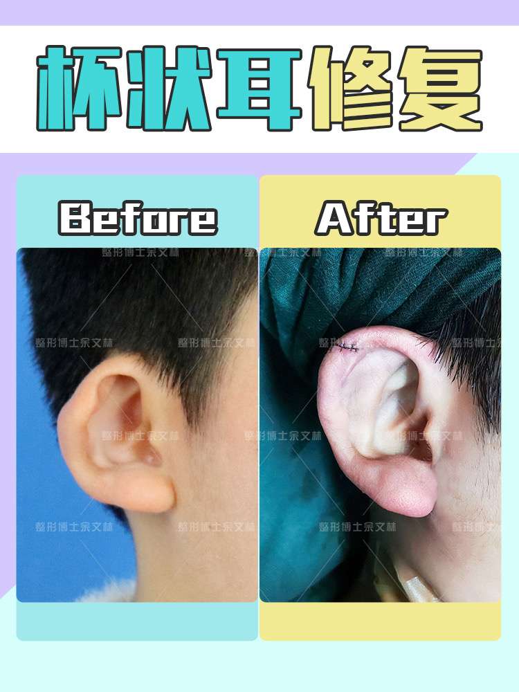 杯状耳矫正耳朵畸形像杯子怎么矫正63