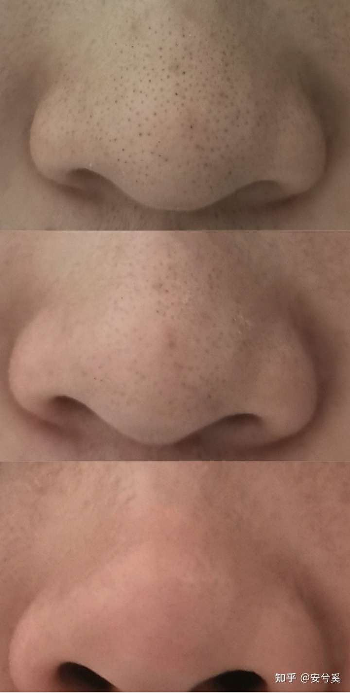 你有试过用夹子把黑头夹出来吗?