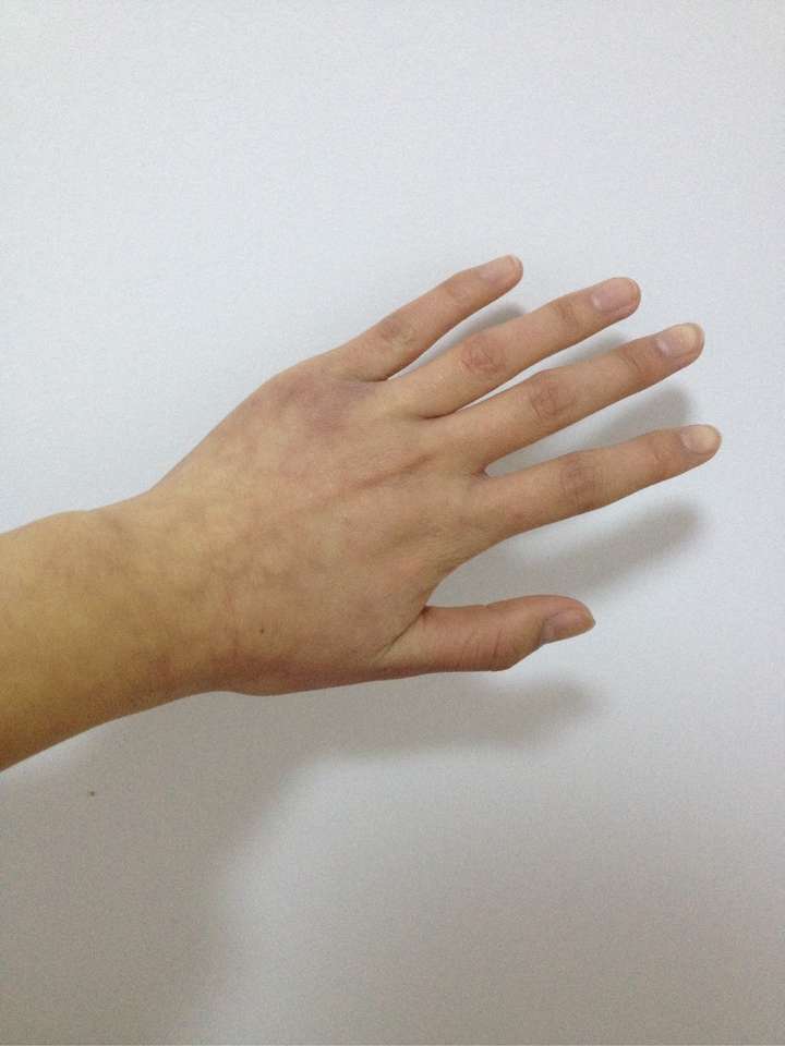 来张图吧,我的手会显露出红色的血管