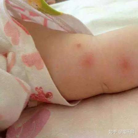 婴儿被蚊虫叮咬涂什么好