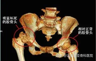 人工全髋关节置换术