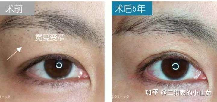 真实日记 年轻5岁的提眉术体验 眉下切 知乎