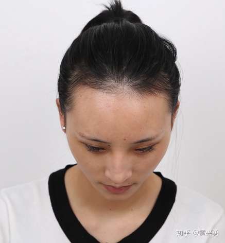 m型发际线一定会秃头吗