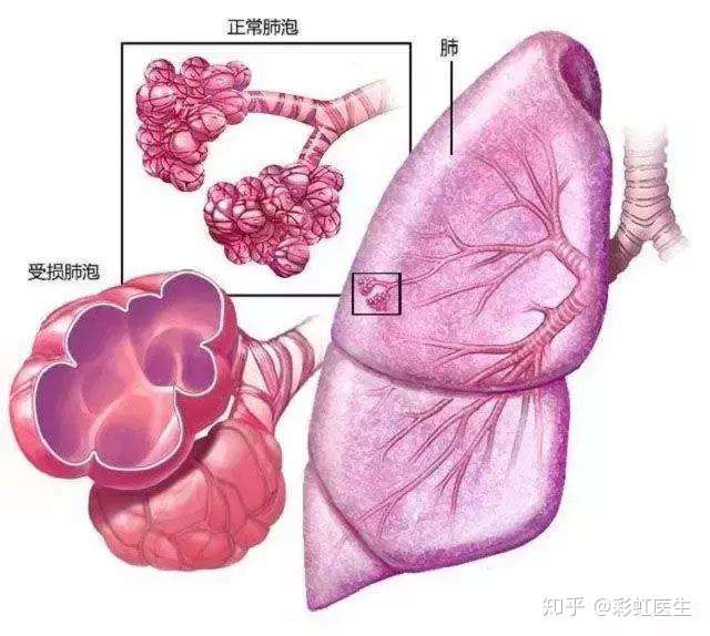 体检发现 肺大疱 怎么办 知乎