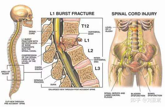 腰椎爆裂性骨折到底是怎么回事 术后为什么有这些症状 知乎