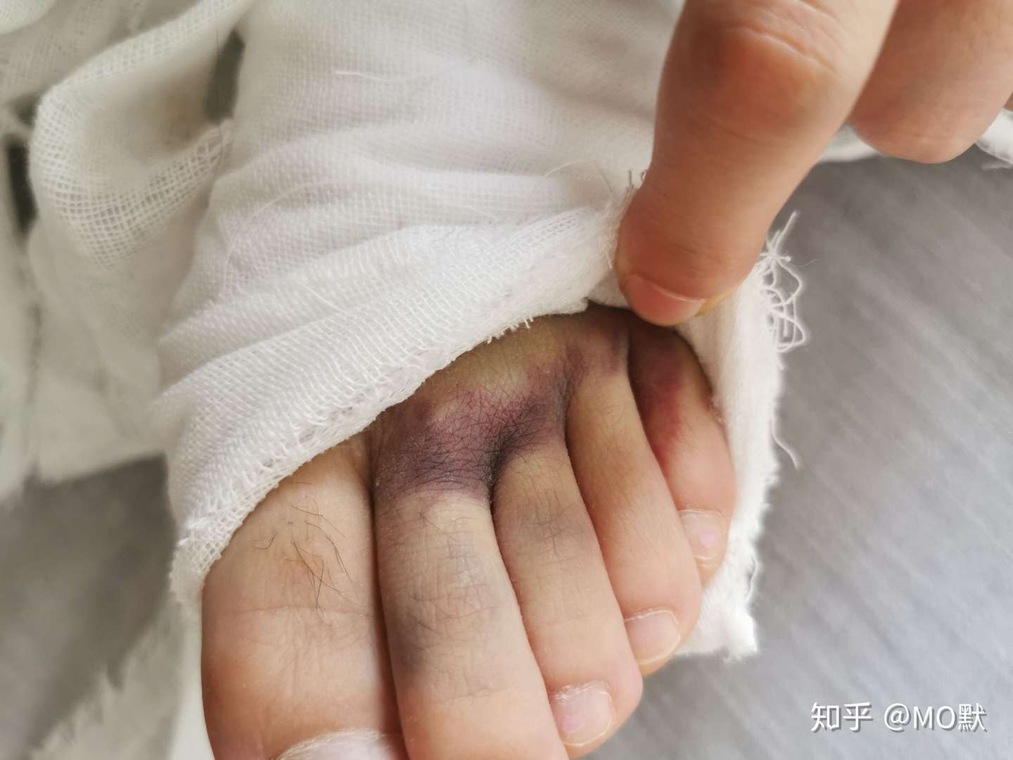 50 小指骨折手 素晴らしいサッカーの写真