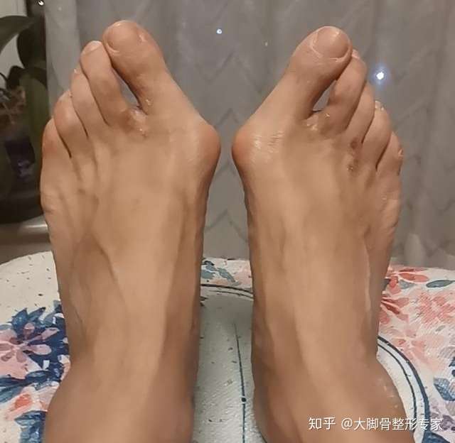 60岁的大脚骨还有必要做手术吗