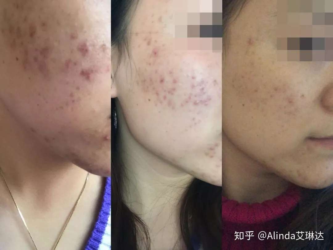 出油长痘毛孔还粗大 点进来帮你变身清新初恋脸 知乎