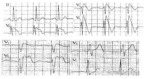 J波与j波综合征 知乎