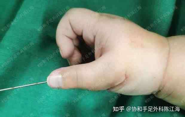 宝宝手上用克氏针疼不疼