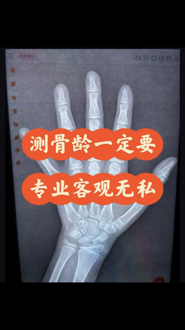 骨龄鉴定徐永剑 的想法: 测骨龄一定要专业客观无私 | 案例分析:2014