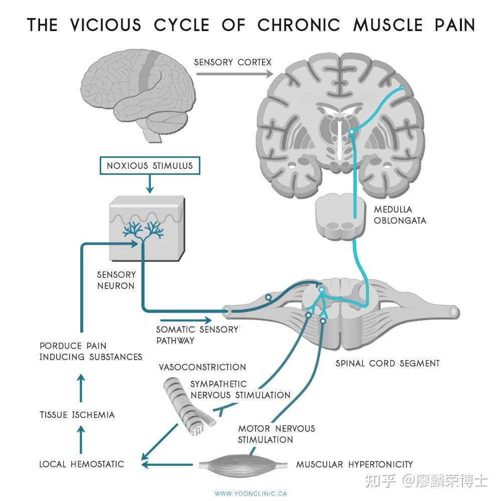 如何判断肌骨疼痛患者有中枢敏化疼痛 知乎