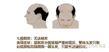 植发多久吃肉好呢(植发后多久才能吃辣)