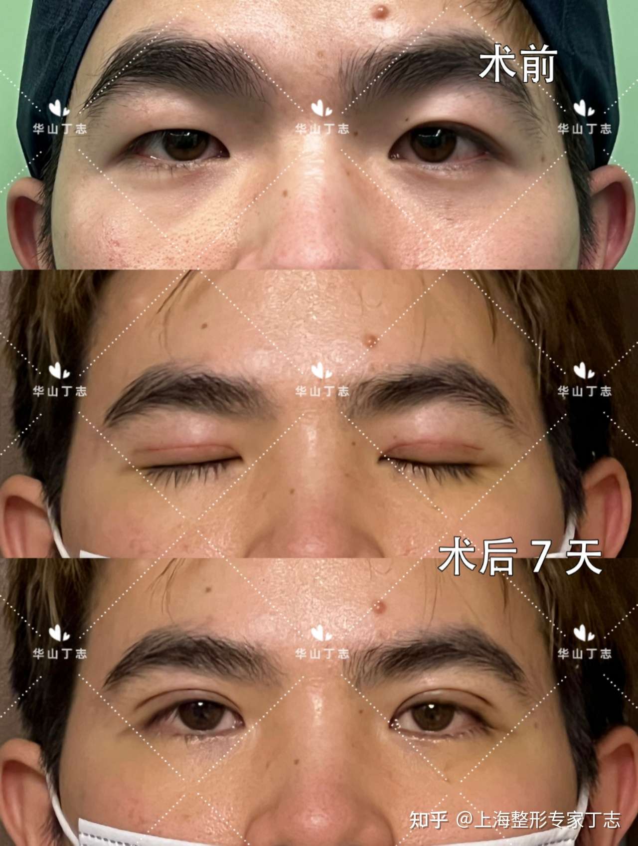 男生大小眼一单一双全切双眼皮术后第7天