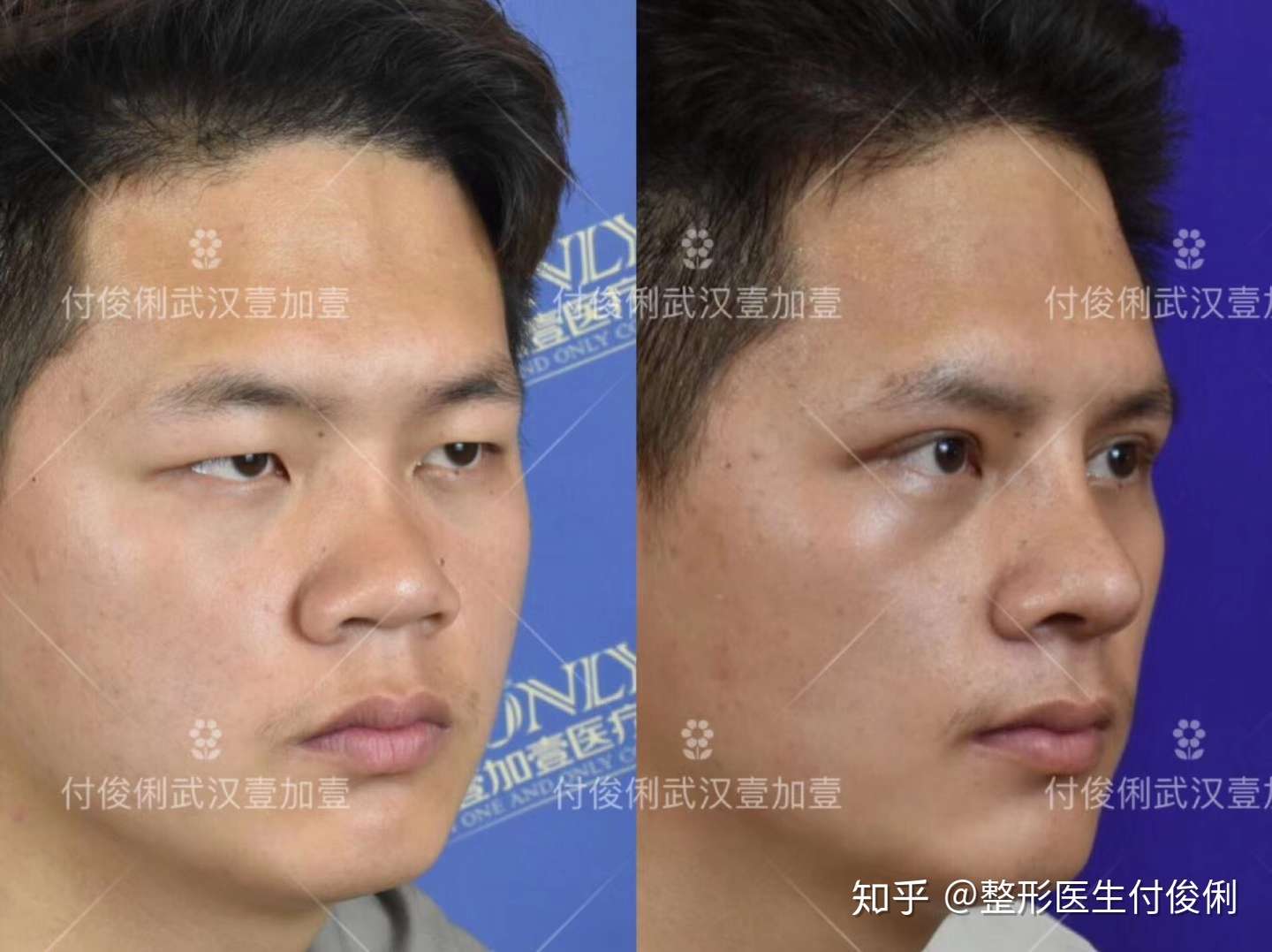 男性隆鼻和女性隆鼻有什么区别吗 知乎