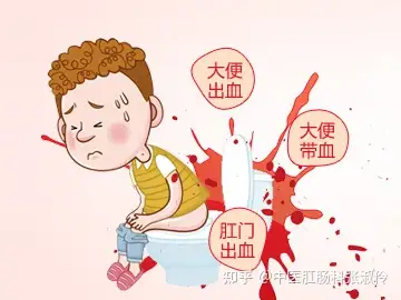 北京東大肛腸醫院肛裂的症狀有哪些