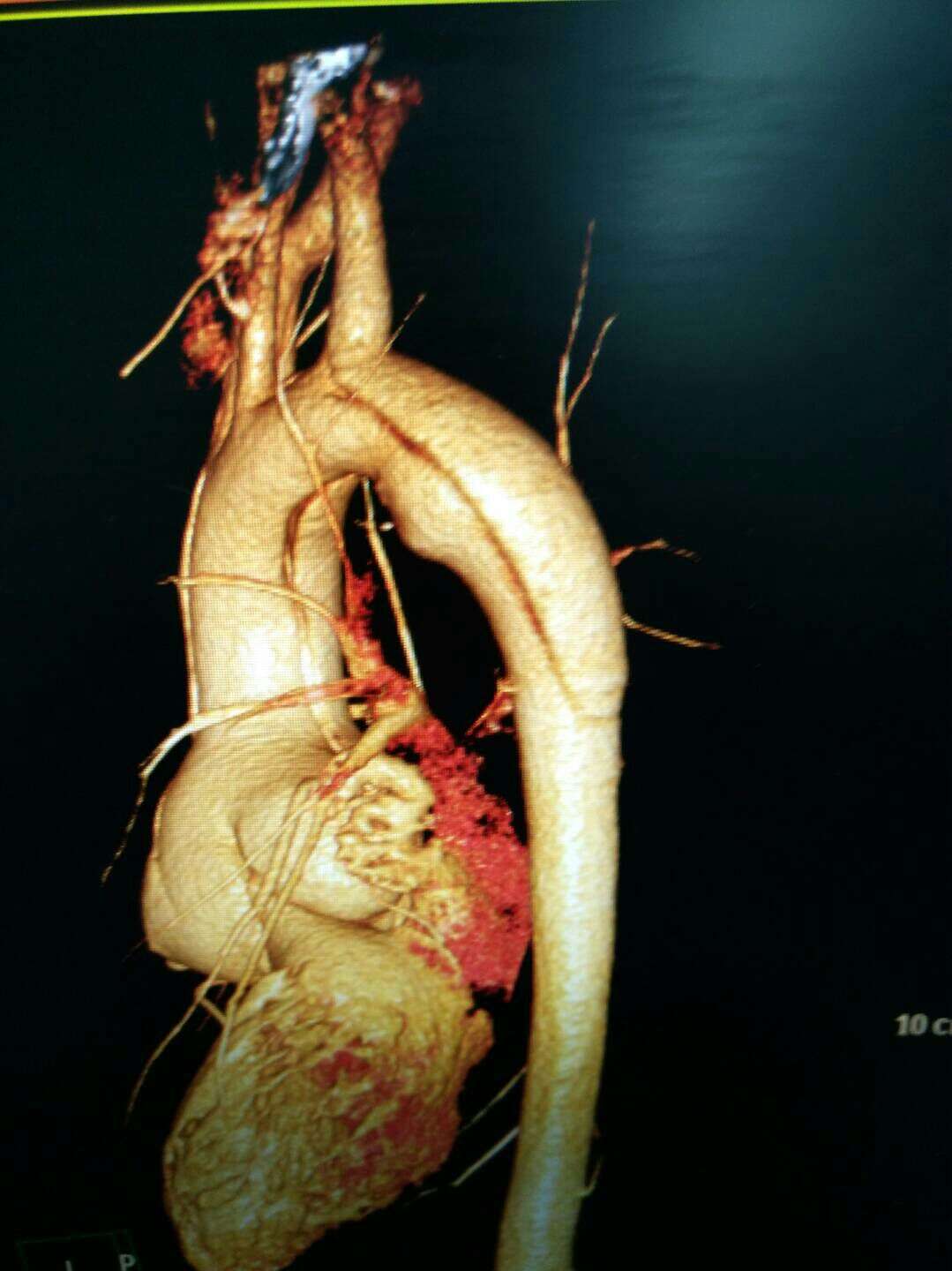 急诊行bentall 全主动脉弓置换 象鼻支架植入术.