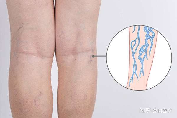 小腿有青筋凸起一定是静脉曲张吗?