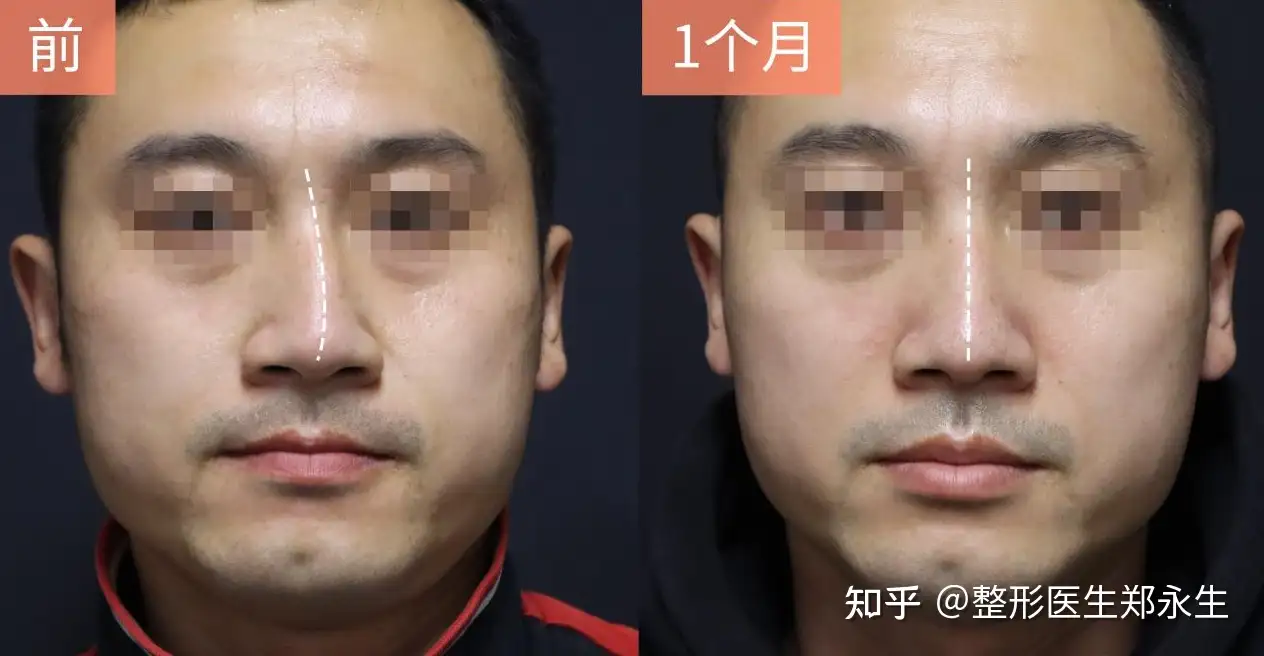 歪鼻矫正后鼻子会变矮吗 会留下瘢痕吗 回答几个大家关心的问题 知乎