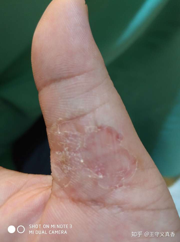 手上蜕皮,一撕就出血,裂口 这是怎么回事,怎么用药?
