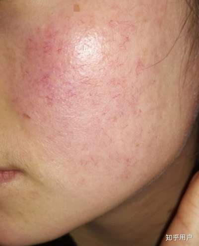 皮肤很不好脸部角质层薄导致皮肤敏感很难看求大神指点