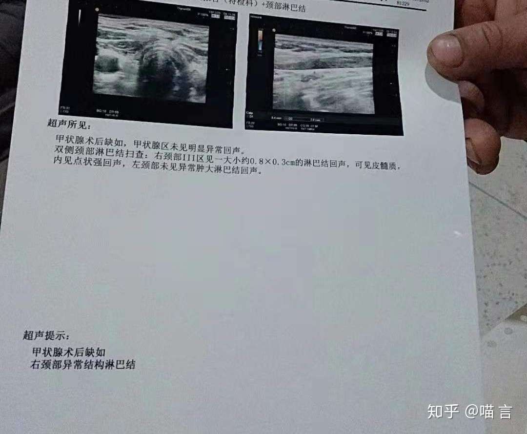 甲状腺癌淋巴转移 知乎
