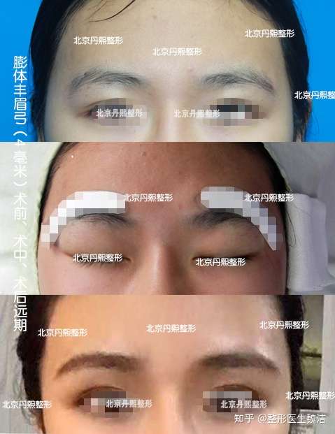 丹熙丰眉弓科普 假体丰眉弓手术是用硅胶还是膨体来垫 知乎