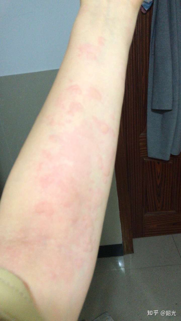 荨麻疹治疗过程分享 知乎