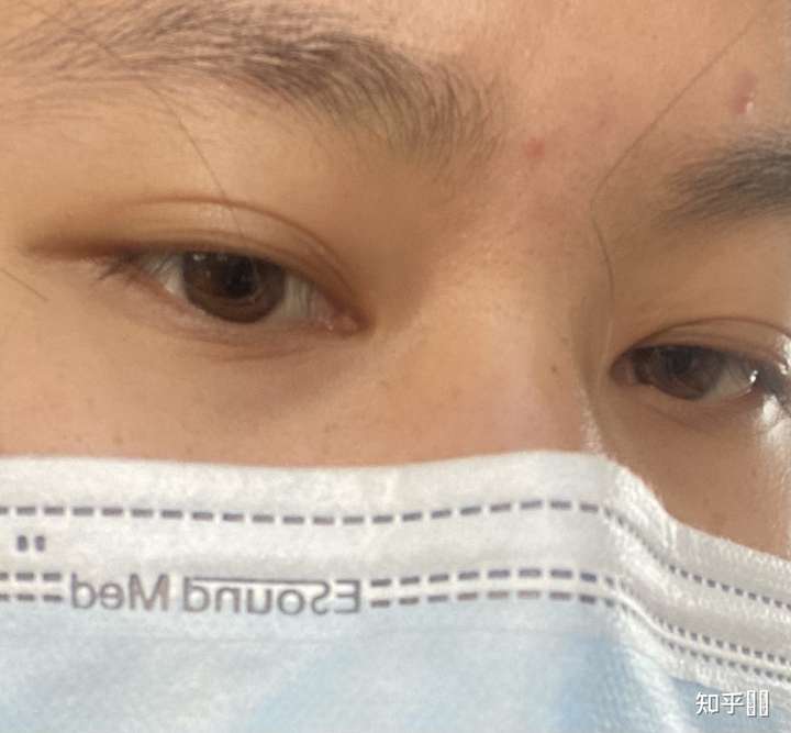 两只眼睛都是三眼皮,下眼皮也有三层哈哈哈哈哈 还挺好看的,基因彩蛋