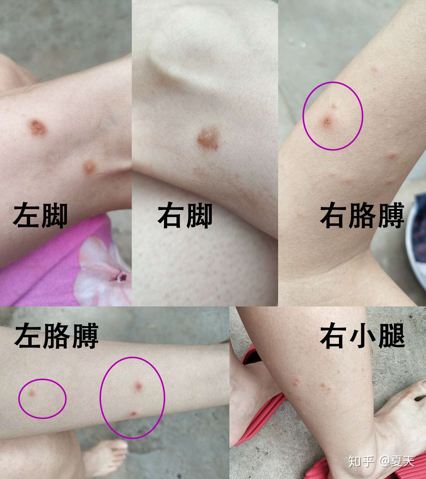 奇痒无比的湿疹治疗历程 知乎