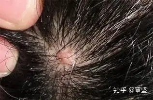 头上长硬硬的小颗粒抠出来感觉超爽这究竟是什么